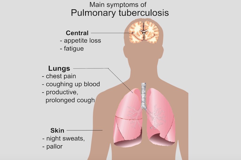 tb information in marathi